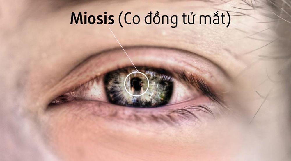 
Đồng tử mắt bị co
