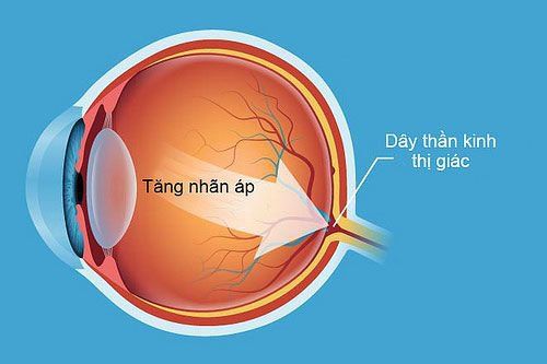 
Soi góc tiền phòng hỗ trợ điều trị tăng nhãn áp
