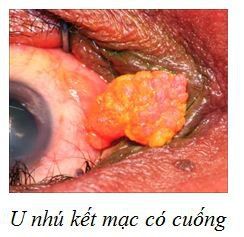
U nhú có cuống được biểu hiện bằng sự tăng sinh của biểu mô dạng nhiều thùy
