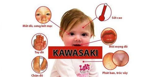 Nếu không được điều trị, trẻ mắc bệnh Kawasaki sẽ có thể bị tổn thương mạch vành