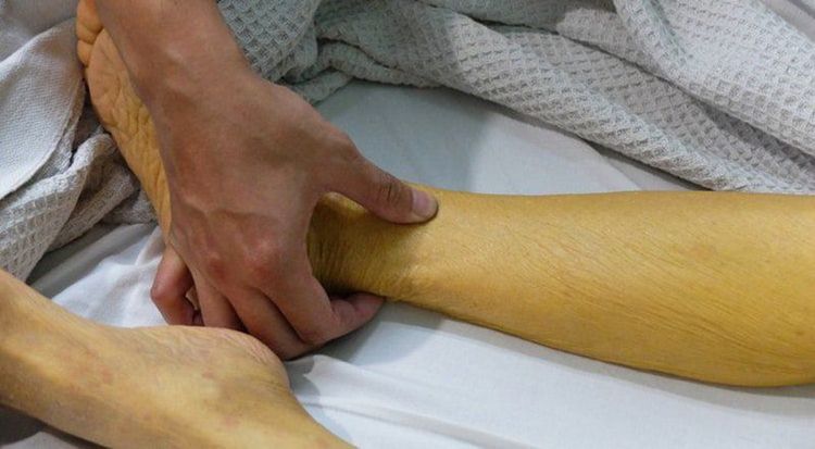 
Người lớn bị u nang ống mật chủ có biểu hiện vàng da
