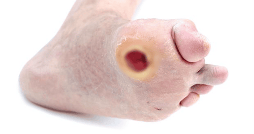 
Điều trị vết loét do tì đè cần tập trung vào hai mục tiêu bao gồm thúc đẩy nhanh quá trình lành vết thương và dự phòng biến chứng của nó
