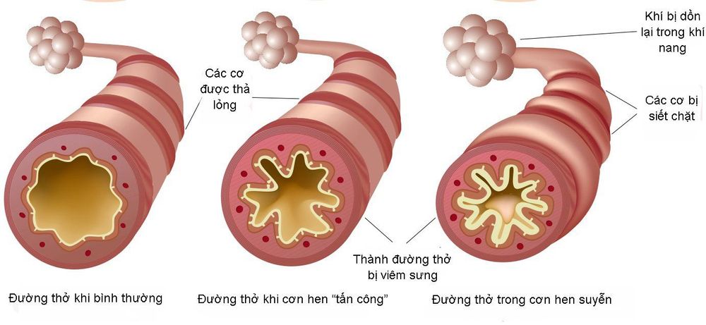 
Co thắt phế quản là một tai biến có thể xảy ra sau chải phế quản

