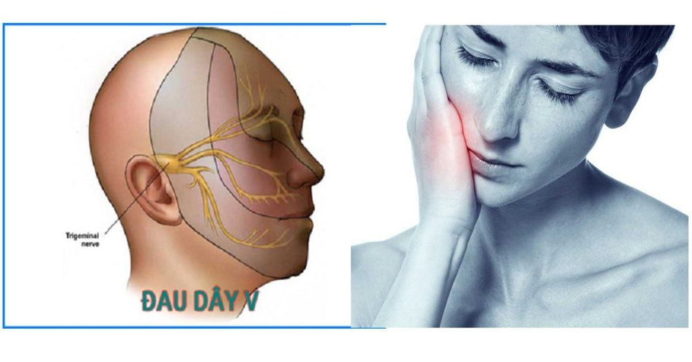 
Chèn ép dây thần kinh là yếu tố dẫn đến bệnh đau dây thần kinh V
