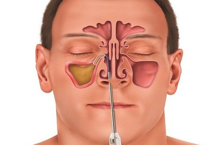 
Nội soi phẫu thuật xoang mũi mang lại nhiều ưu điểm vượt trội
