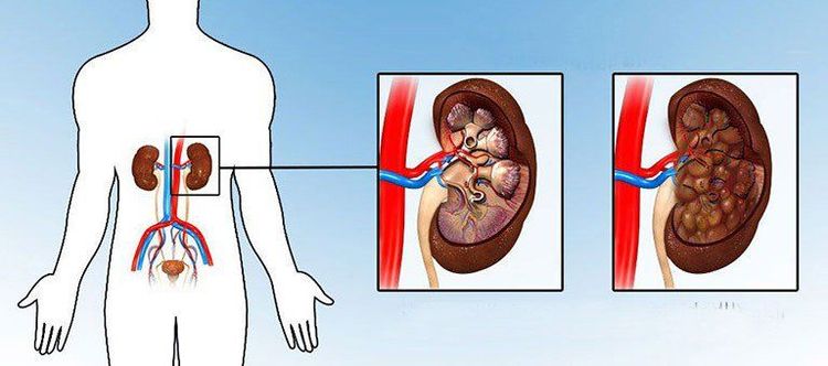 
Bệnh cảnh hoại tử gai thận
