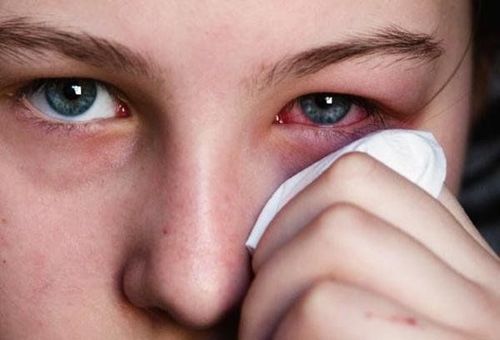 
Những rủi ro và tác hại khi đeo kính áp tròng thường xuyên
