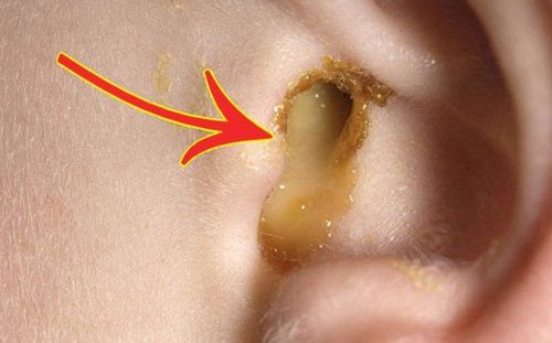 
Viêm tai giữa mãn tính là tình trạng chảy mủ tai kéo dài dai dẳng
