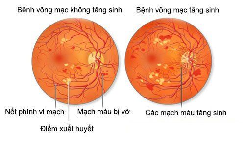 
Bệnh võng mạc không tăng sinh và bệnh võng mạc tăng sinh
