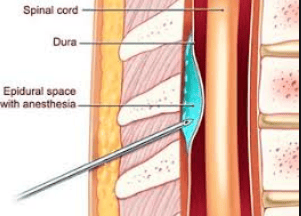 
Dán máu màng cứng tự thân là biện pháp tiêm máu tự thân vào khoang ngoài màng cứng
