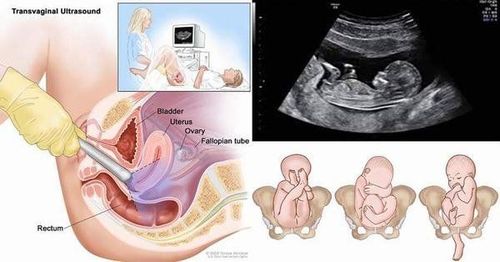 
Siêu âm thai với đầu dò âm đạo
