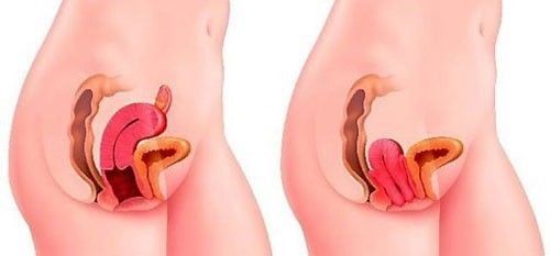 
Sa tử cung cấp độ 1
