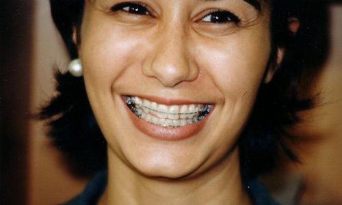 
Giải đáp 40 tuổi niềng răng được không?
