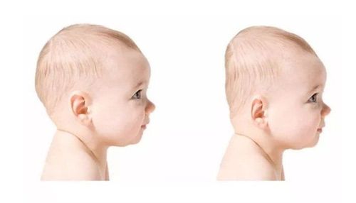 
Hội chứng đầu phẳng thường không gây bất kỳ vấn đề gì nghiêm trọng bởi nó không ảnh hưởng đến não và hình dạng đầu sẽ cải thiện theo thời gian
