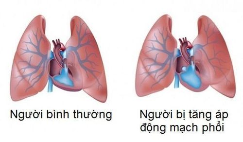 
Người bị tăng áp động mạch phổi sẽ được chỉ định siêu âm Doppler tim
