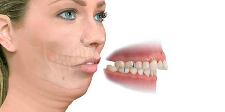 
Ví dụ về hình ảnh răng vẩu hàm trên
