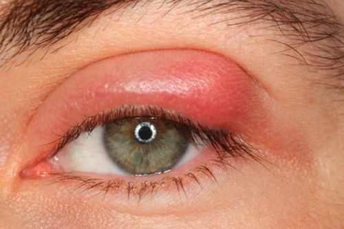 
Nặn tuyến bờ mi được chỉ định trong các trường hợp viêm bờ mi
