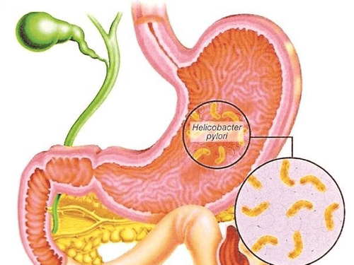 
Vi khuẩn H. pylori kéo dài nhiễm trùng gây ra viêm dạ dày mãn tính
