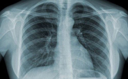 
Chụp CT phổi là phương pháp an toàn, ít có tác dụng phụ
