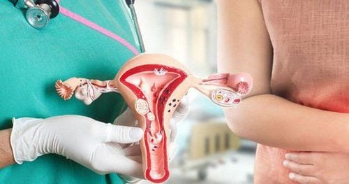 Lạc nội mạc trong cơ tử cung là một bất thường của vị trí niêm mạc tử cung bị sai chỗ 