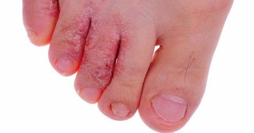 
Người bệnh nấm da chân nên đến gặp bác sĩ để được điều trị kịp thời
