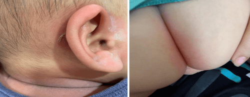 Hội chứng bong da do tụ cầu: Những điều cần biết