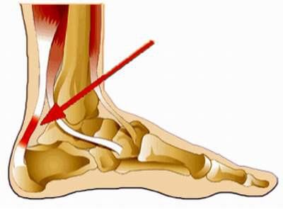 
Vị trí gân Achilles
