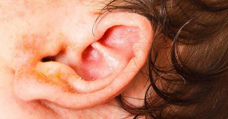 
Chảy nước vàng ở vành tai có thể do một số nguyên nhân khác nhau gây ra
