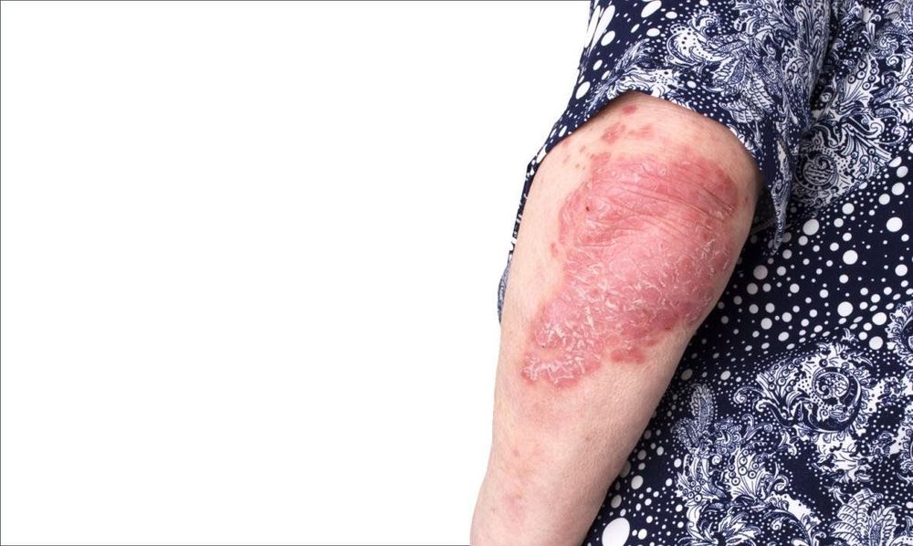 
Bệnh nhân bị viêm khớp vảy nến

