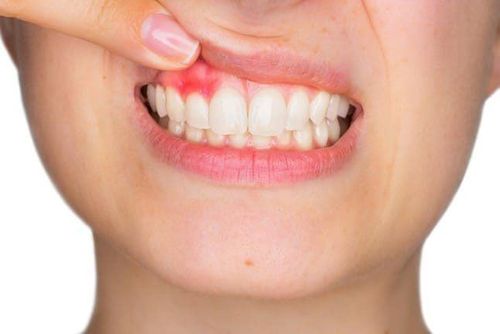 
Áp xe trong miệng ảnh hưởng nghiêm trọng đến vị giác của bạn
