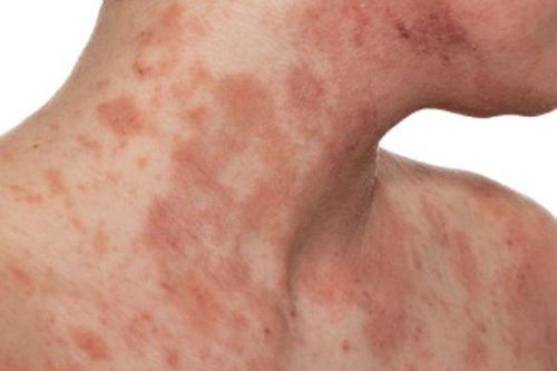
Viêm da cơ địa để lại sẹo thâm và ngứa ngáy ở các vị trí như cổ, tay, chân,...
