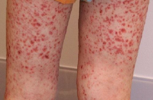 
Bệnh nhân bị viêm mao mạch dị ứng
