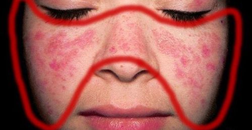 
Bệnh lupus ban đỏ dạng đĩa vùng sống mũi và hai má
