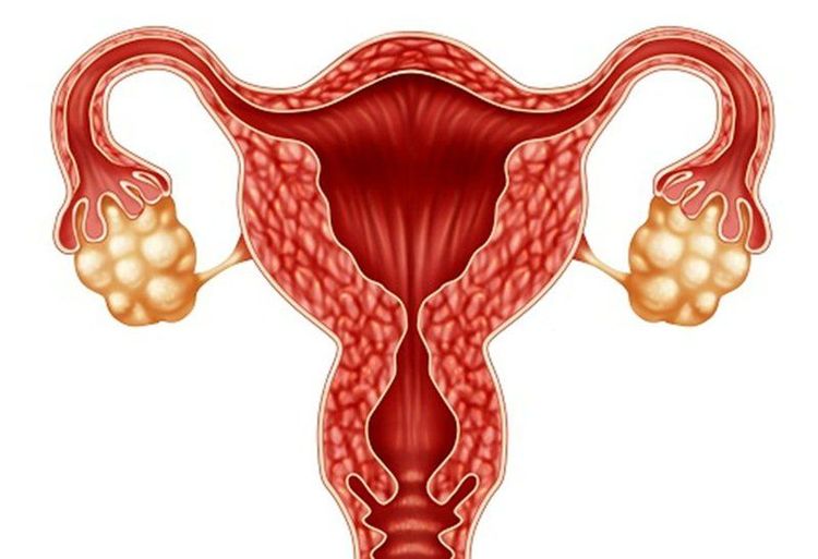 Mắc đa nang buồng trứng kèm tiết dịch âm đạo vàng có sao không?