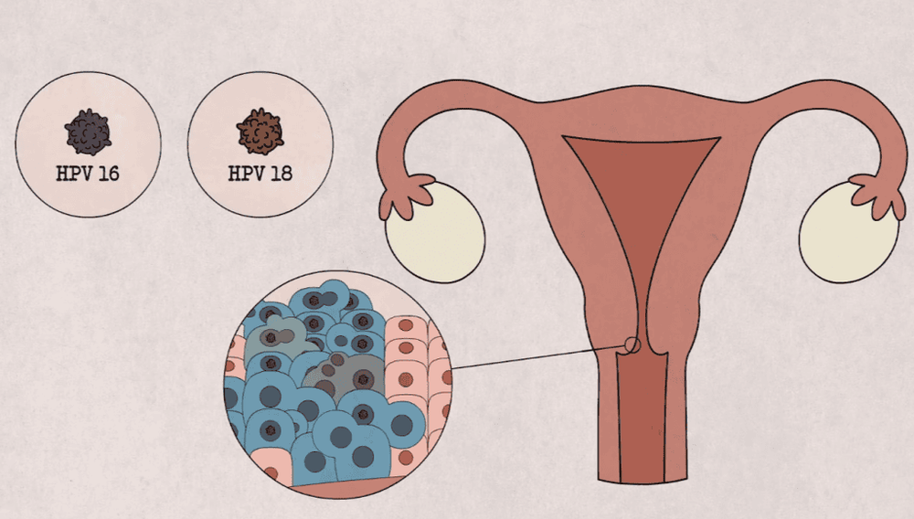 
Virus HPV 16 và 18 là hai type chủ yếu gây bệnh ung thư cổ tử cung
