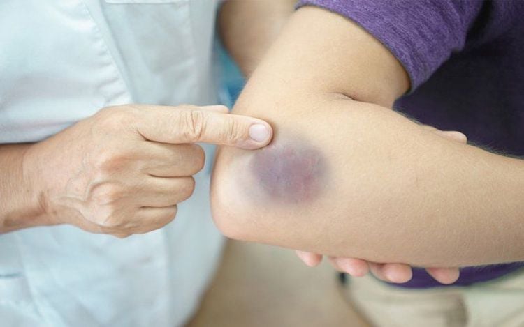 
Rối loạn tiểu cầu gây ra những xuất huyết dưới da
