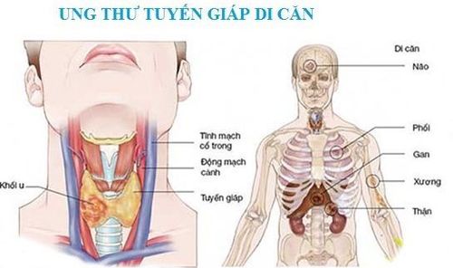 Ung thư tuyến giáp di căn là một ung thư hiếm gặp