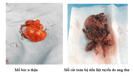 
Mổ bóc u thận và mổ cắt toàn bộ tiền liệt tuyến do ung thư
