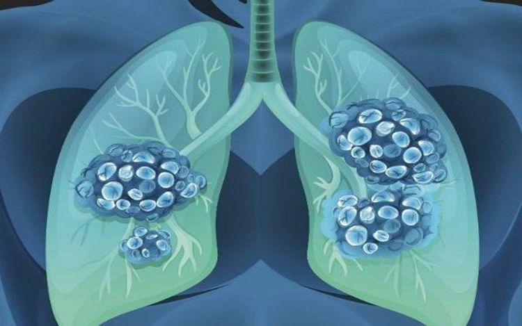 
Thở máy giúp ngăn ngừa tình trạng suy hô hấp ở người bệnh
