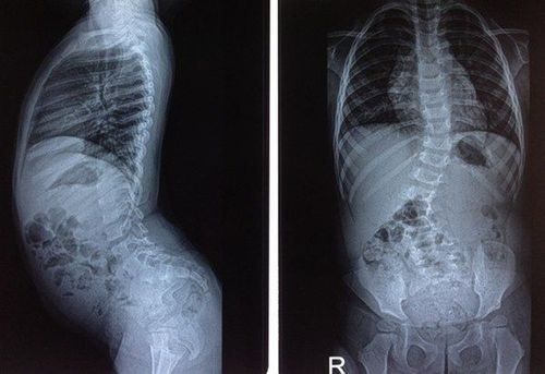 
Lao cột sống khiến người bệnh bị chấn thương và cong vẹo cột sống
