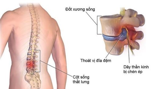 
Dây thần kinh bị chèn ép gây ra hội chứng rễ thần kinh
