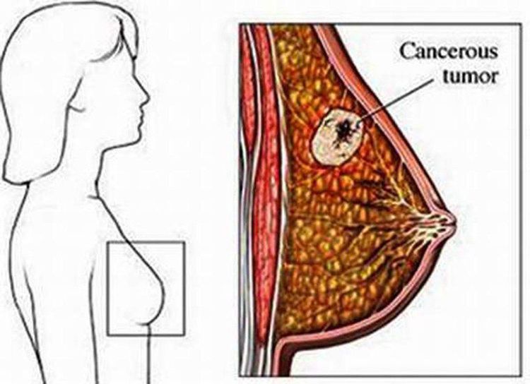 
Nổi cục ở vú có thể là dấu hiệu của bệnh u vú hoặc ung thư vú
