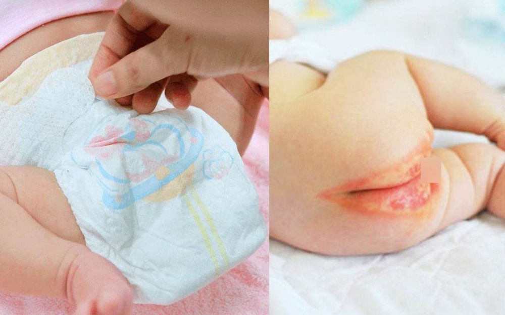 
Nắng nóng, trẻ dễ bị viêm da do dùng bỉm quá nhiều
