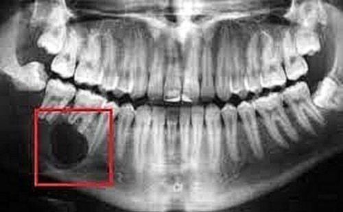 Viêm chân răng có mủ: Nguyên nhân và cách điều trị