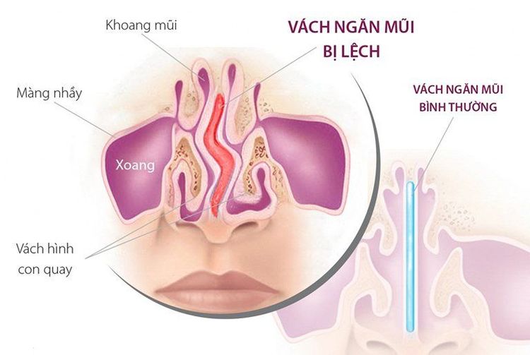 
Hình ảnh mô tả vẹo vách ngăn mũi
