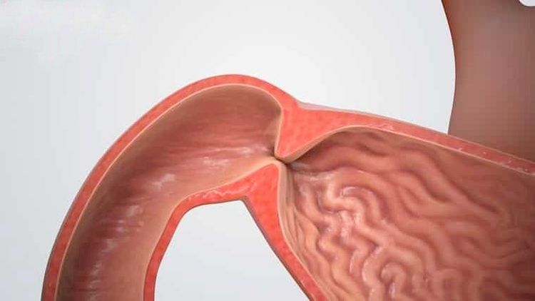
Tình trạng hẹp môn vị do bệnh loét hành tá tràng
