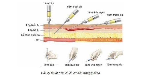 
Các kĩ thuật tiêm cơ bản trong y khoa
