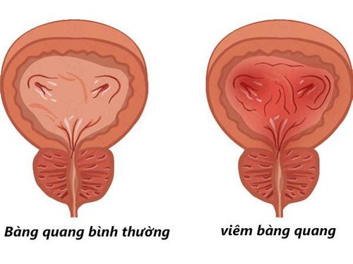 
Tình trạng bàng quang viêm có thể gây tiểu máu
