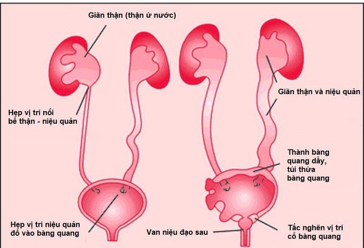 
Tắc nghẽn niệu đạo dẫn tới bệnh viêm phổi cấp tính
