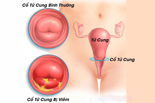 
Viêm niêm mạc tử cung gây biến chứng viêm cổ tử cung
